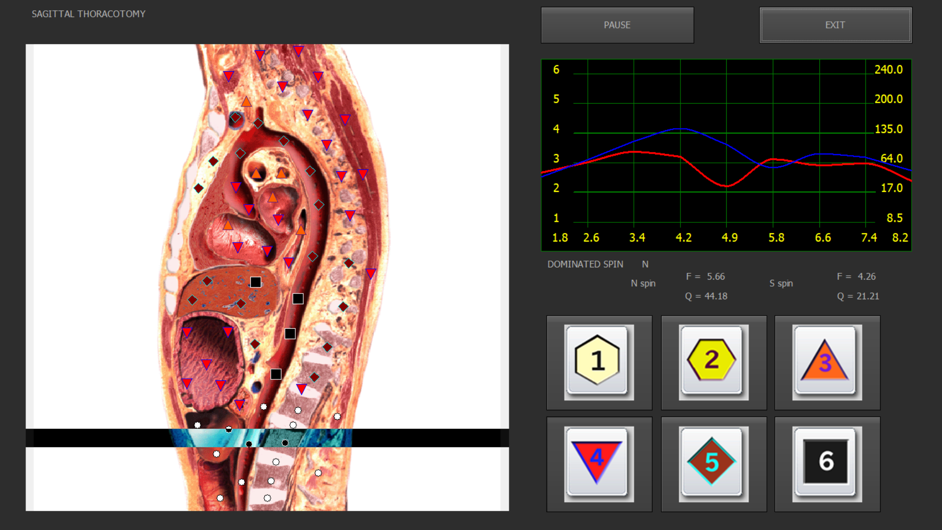 Quantum Meta Health QMH-SCAN-Thoracotomy